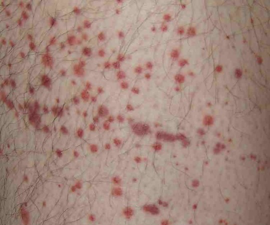 AZ疫苗又爆另一罕見副作用 留下紫紅色點狀皮疹